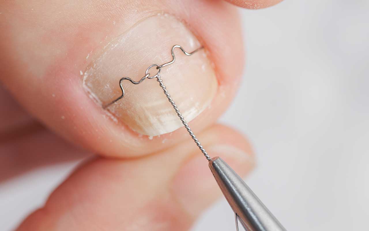 Erweiterte Dokumentationsanforderungen Nagelspangenbehandlung